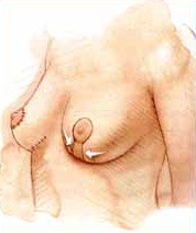 http://www.surgery.org/sites/default/files/breastlift-c1.jpg