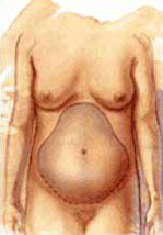 http://www.surgery.org/sites/default/files/tummytuck1.jpg