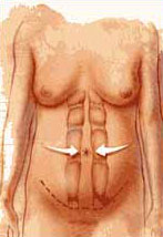 http://www.surgery.org/sites/default/files/tummytuck2.jpg