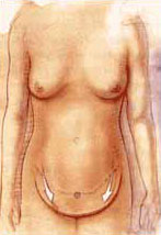 http://www.surgery.org/sites/default/files/tummytuck3.jpg